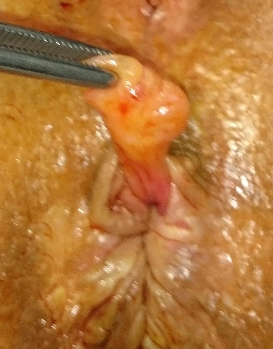 CLOACOGENIC POLYP