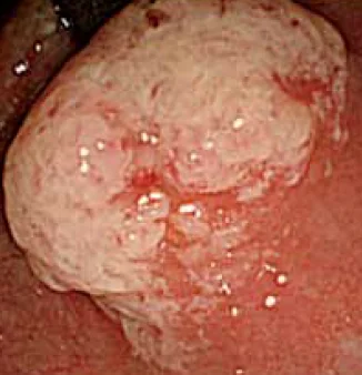 CLOACOGENIC POLYP 