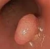 CLOACOGENIC POLYP
