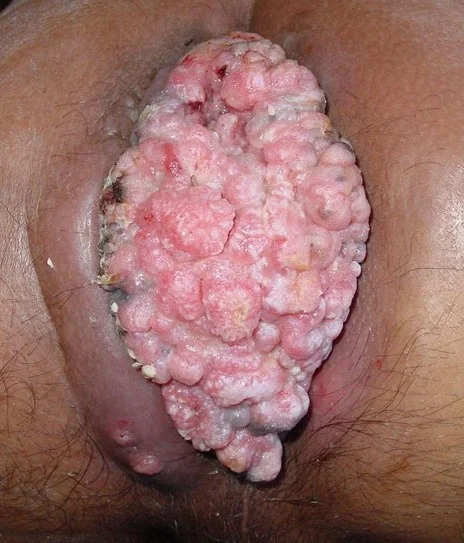 PERINEAL CONDYLOMATA