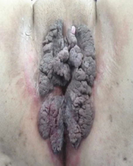 PERINEAL CONDYLOMATA