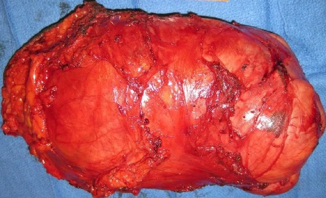 PERINEAL LEIOMYOMA