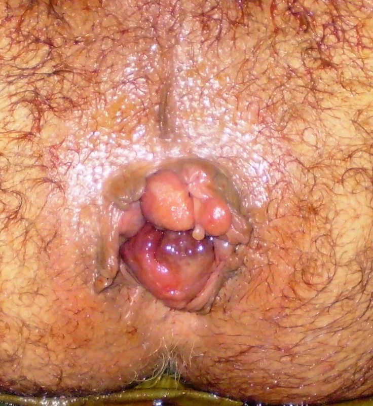 HAEMORRHOIDS - ANAL TAGS