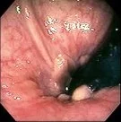 ANAL PAPILLAE