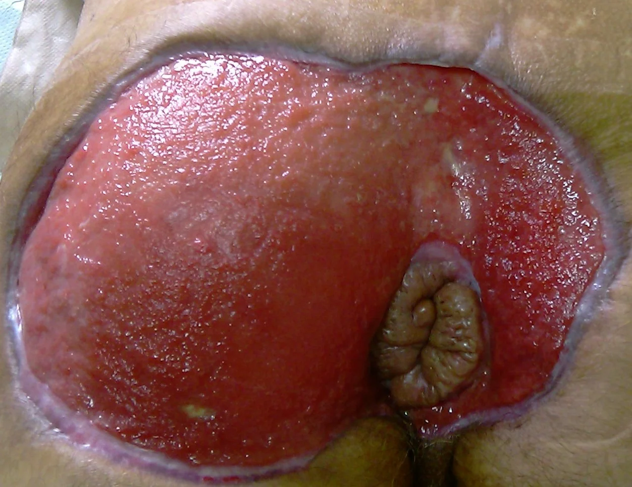 COMPLETELY HEALED PERINEUM