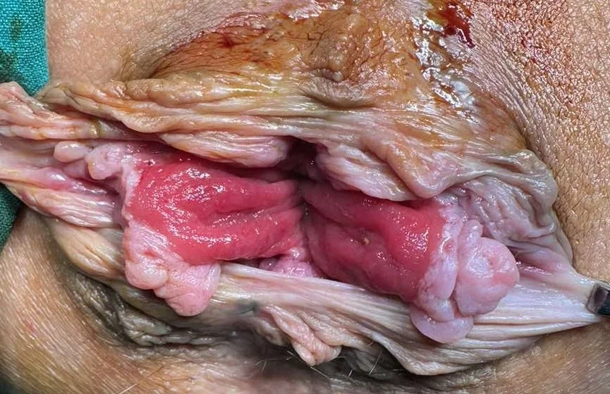 RECTAL MUCOSA PROLAPSE