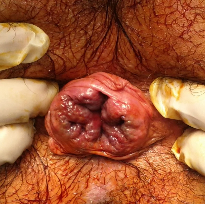 PROLAPSED HAEMORRHOIDS