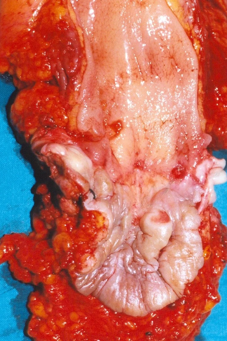 ANAL CARCINOMA