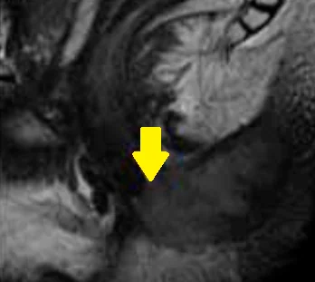 PERIANAL SQUAMOUS CELL CARCINOMA