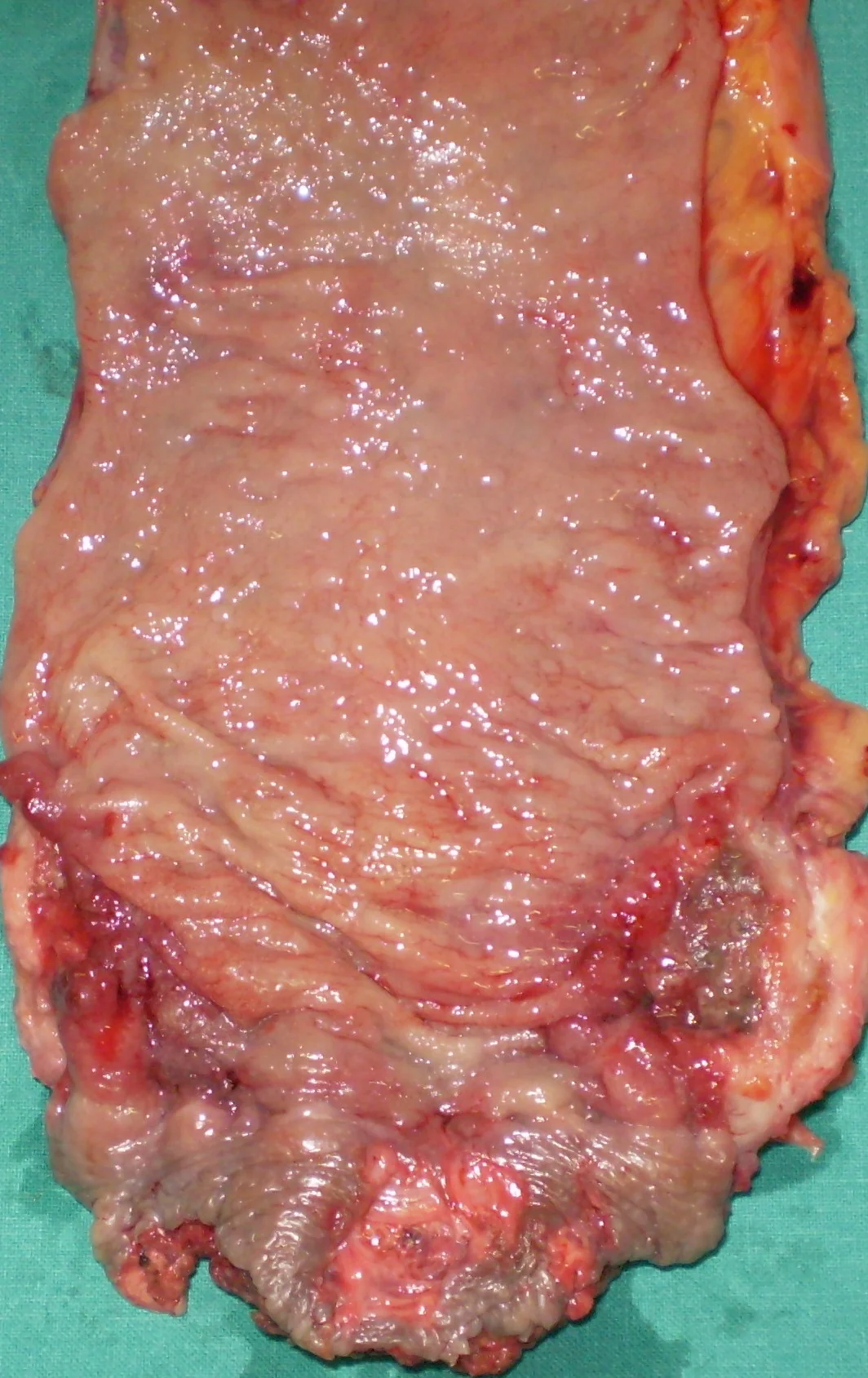 ANAL CARCINOMA