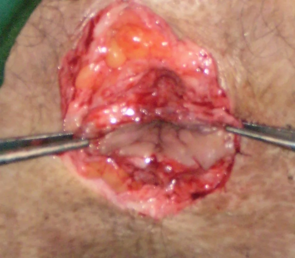 ANAL STENOSIS