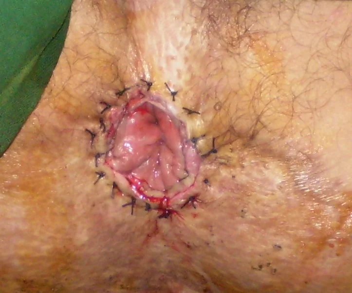 ANAL STENOSIS REPAIR