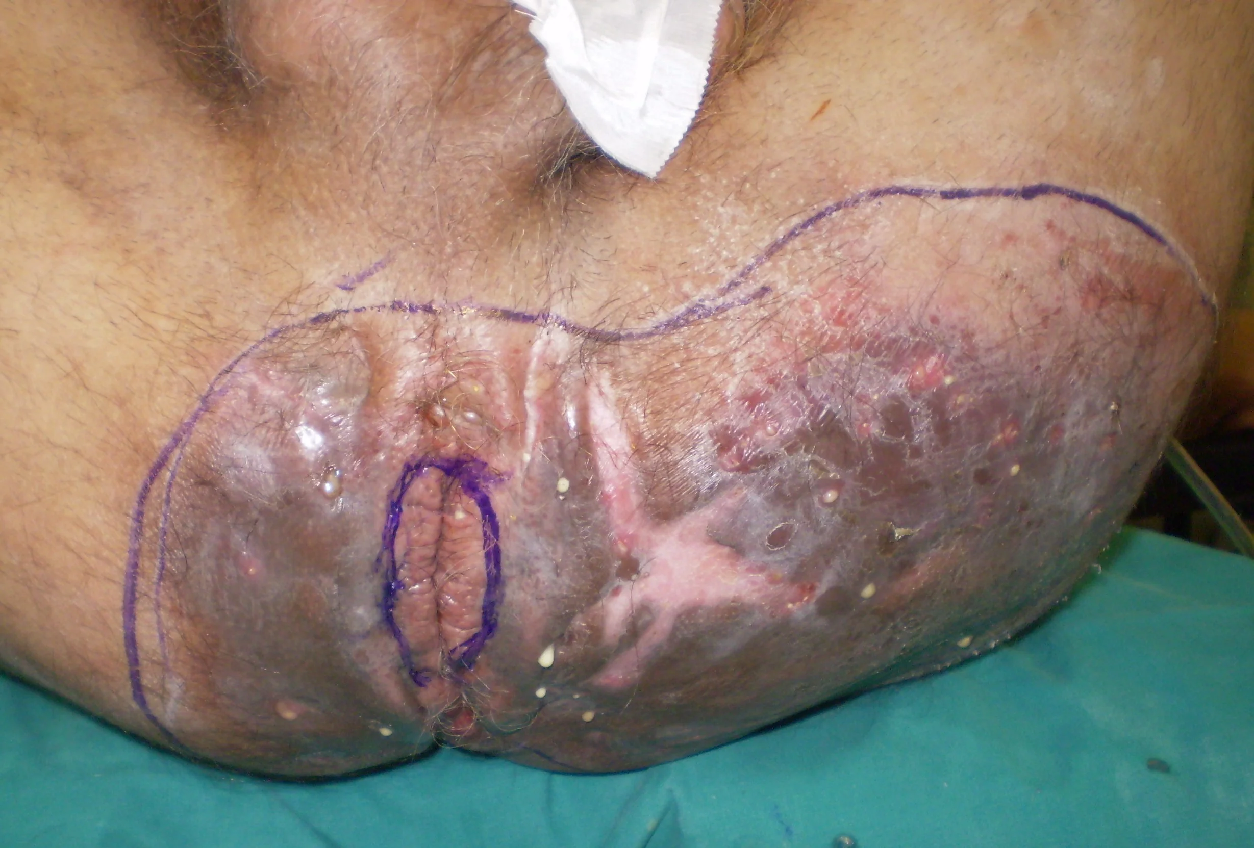 SUPPURATING PERINEAL FISTULAS