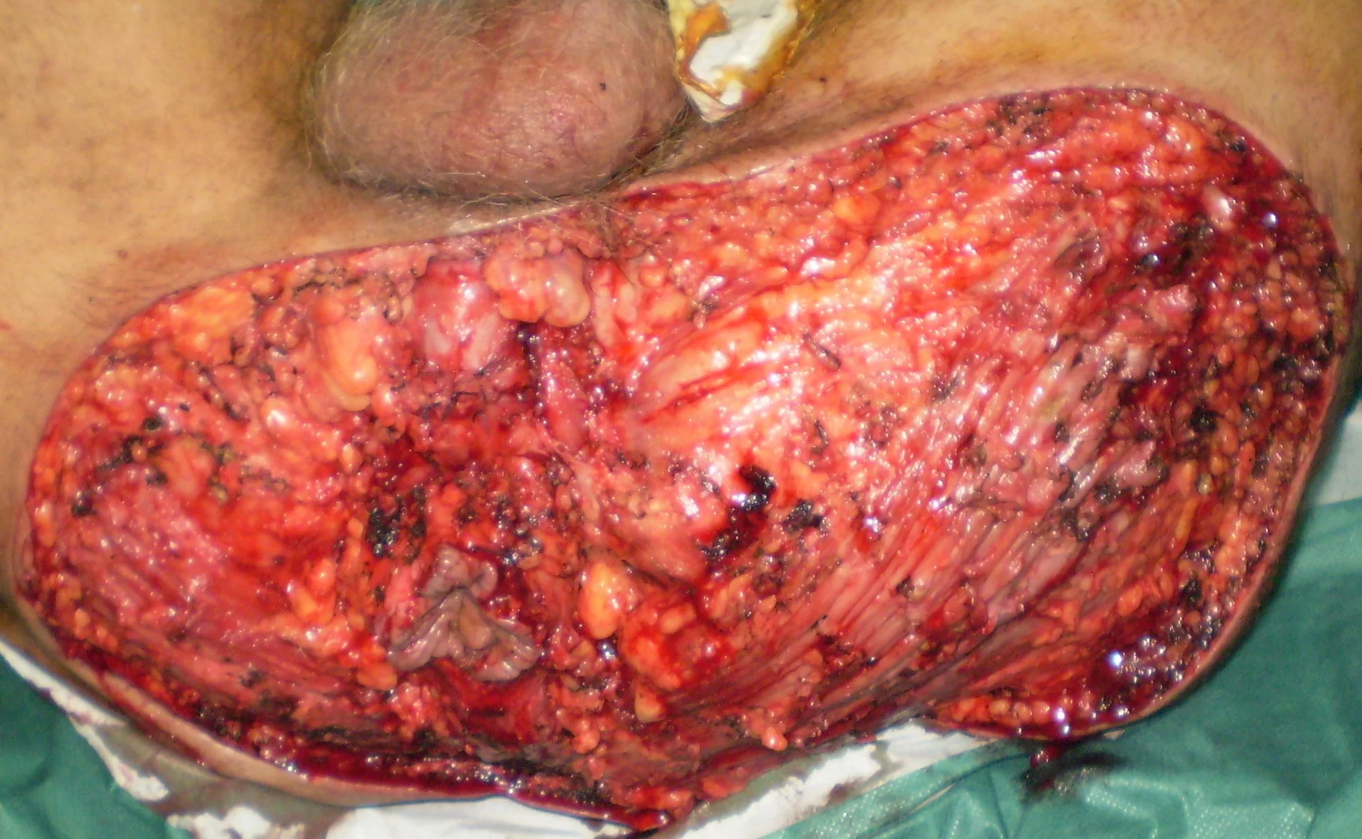 EXCISION SUPPURATING PERINEAL FISTULAS