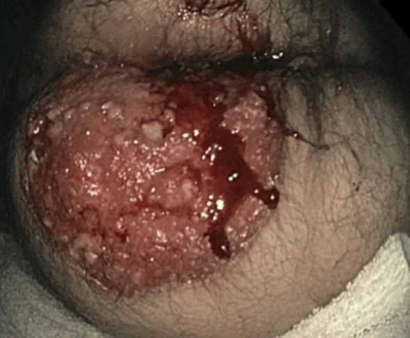 PERIANAL SQUAMOUS CELL CARCINOMA