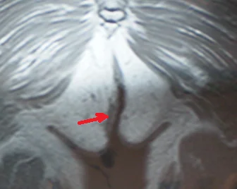 PERIANAL FISTULA