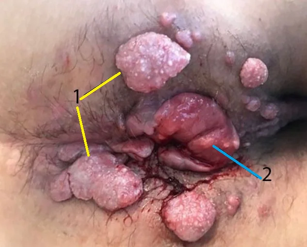 PERIANAL SQUAMOUS CELL CARCINOMA + WARTS