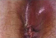 PERIANAL ABSCESS