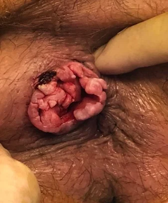 PERIANAL SQUAMOUS CELL CARCINOMA
