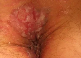 PERIANAL SQUAMOUS CELL CARCINOMA