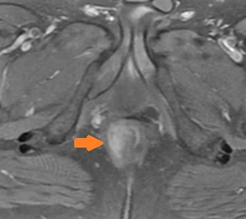PERIANAL SQUAMOUS CELL CARCINOMA