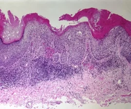 PERIANAL SQUAMOUS CELL CARCINOMA