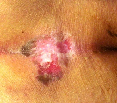 PERIANAL SQUAMOUS CELL CARCINOMA