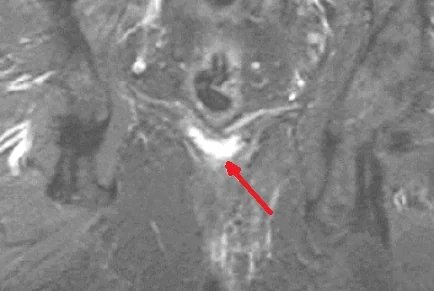 PERIANAL FISTULA