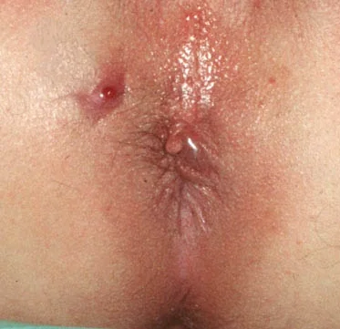 PERIANAL FISTULA