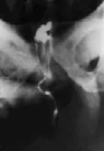 FISTULOGRAPHY