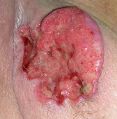 PERINEAL SQUAMOUS CELL CARCINOMA