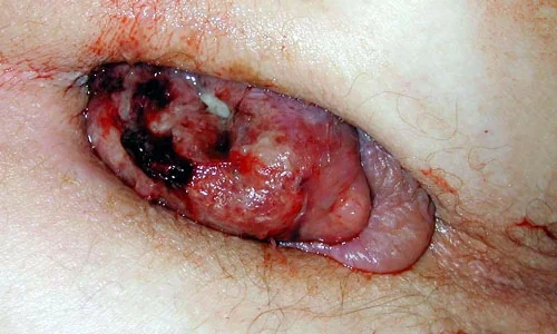 THROMBOSED HAEMORRHOID