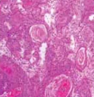 PERIANAL SQUAMOUS CELL CARCINOMA