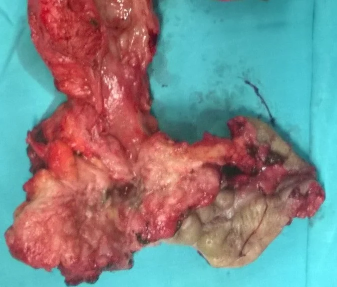 ANAL CARCINOMA