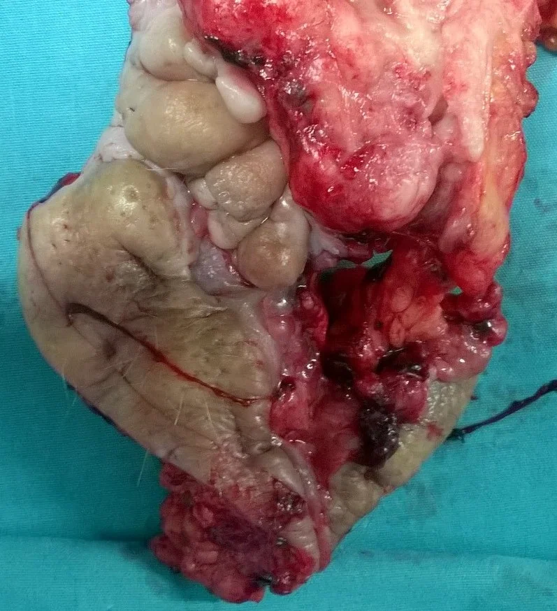 ANAL CARCINOMA