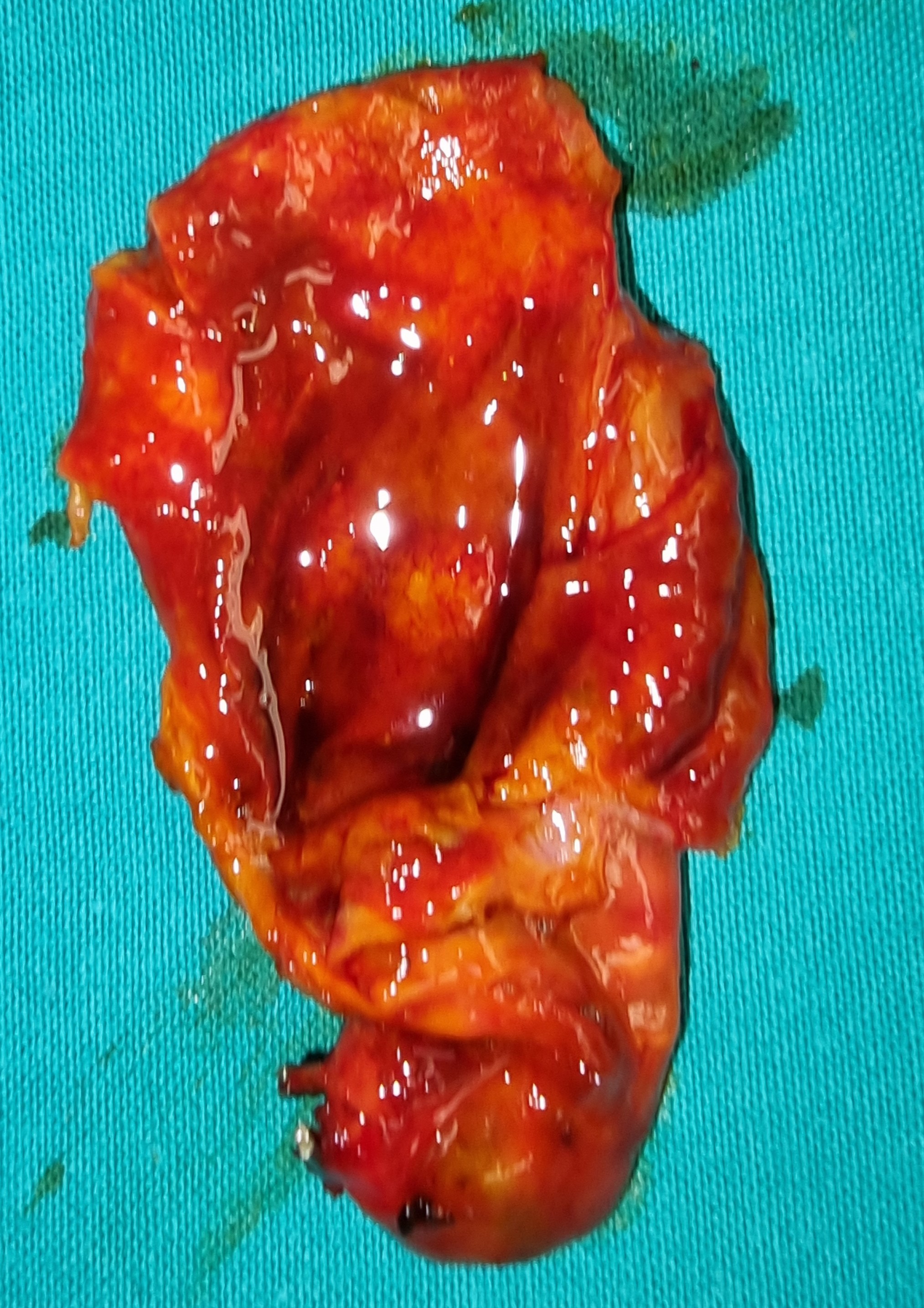 ACUTE APPENDICITIS