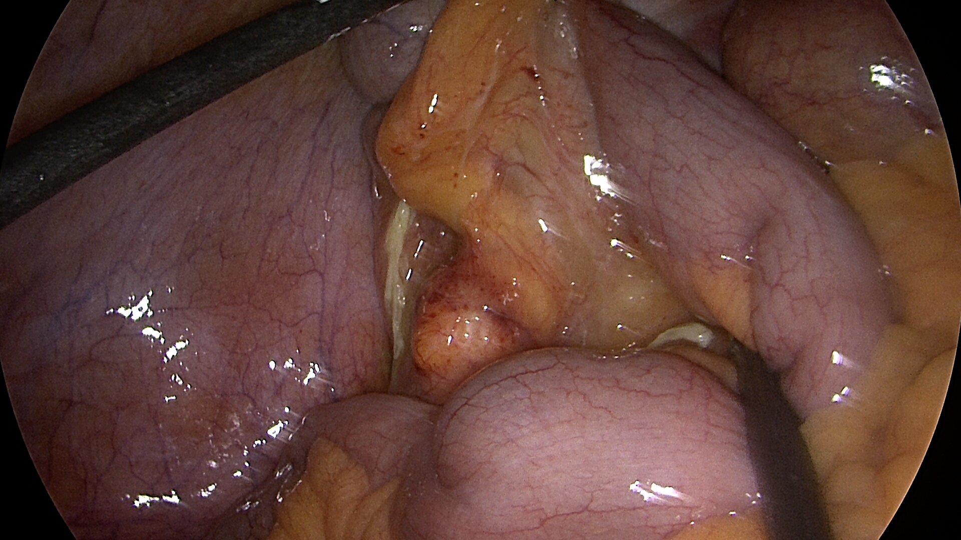 RETROCAECAL APPENDICITIS