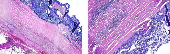 APPENDICULAR MUCOCELE