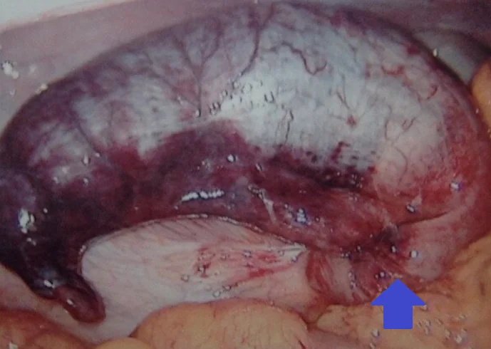 APPENDICULAR MUCOCELE