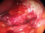 APPENDICULAR MUCOCELE