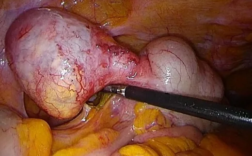 APPENDICULAR MUCOCELE