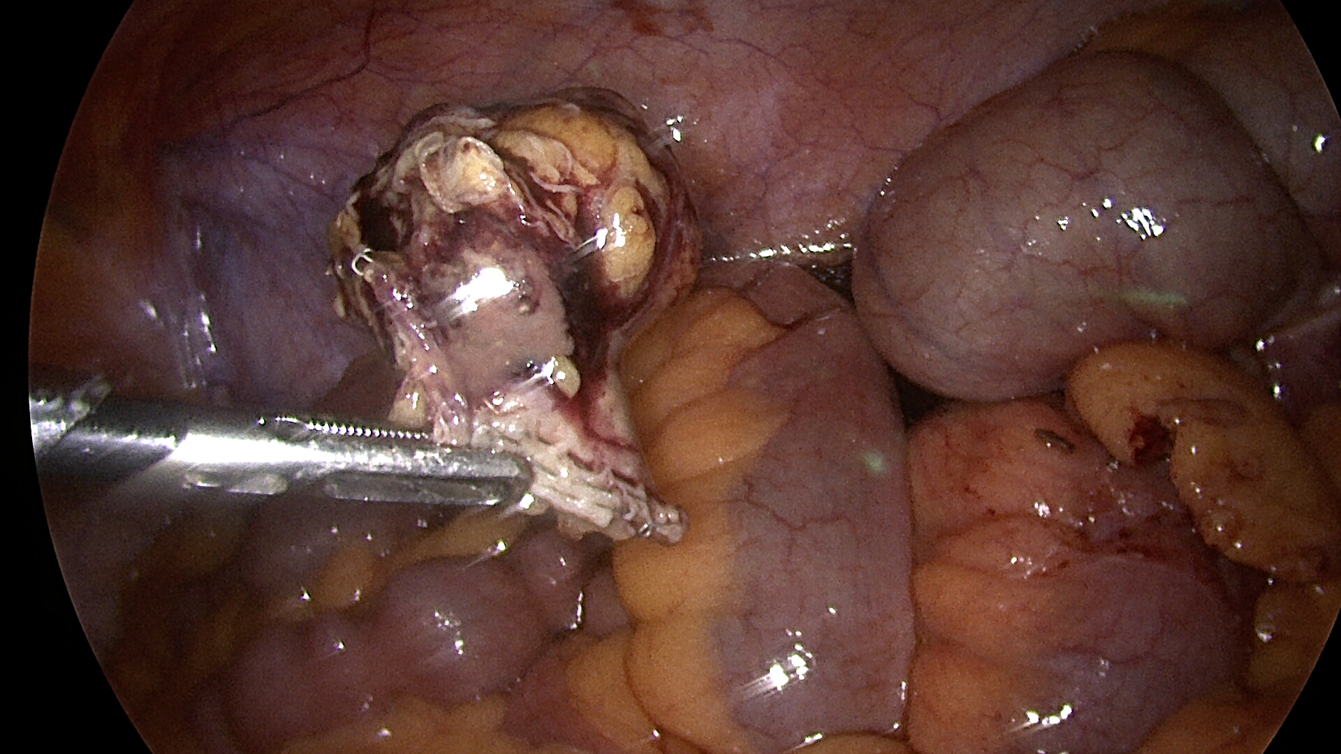 EXCISED INFLAMED APPENDIX 