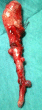APPENDICULAR DIVERTICULA