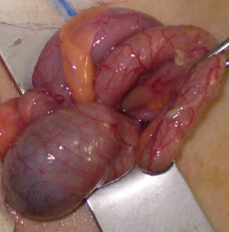 INFLAMED APPENDICITIS