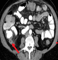 RETROCECAL APPENDIX