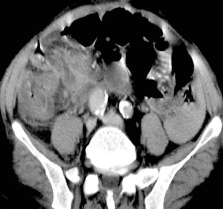 ACUTE LEUCAEMIC APPENDICITIS