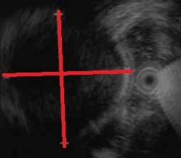 APPENDICULAR MUCOCELE - ECHO IMAGE