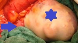 APPENDICEAL MUCOCELE