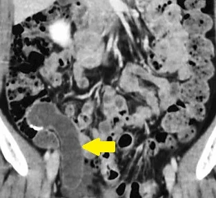 APPENDICEAL MUCOCELE AND ULCERATIVE COLITIS