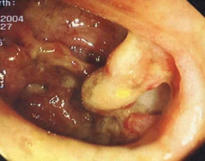 APPENDICULAR - SIGMOID FISTULA